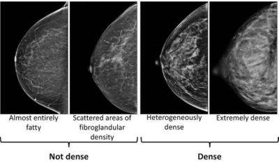 Associated Press - Dense breasts can make it harder to spot cancer on mammogram - manilatimes.net - Usa - city Houston - city Seattle