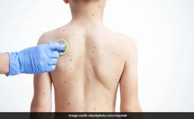 Metro Manila - Reuters - Teodoro Herbosa - Philippines Confirms 2 New Mpox Cases, Says They Are "Milder Variant" - ndtv.com - Philippines - state Indiana - city Manila - Congo